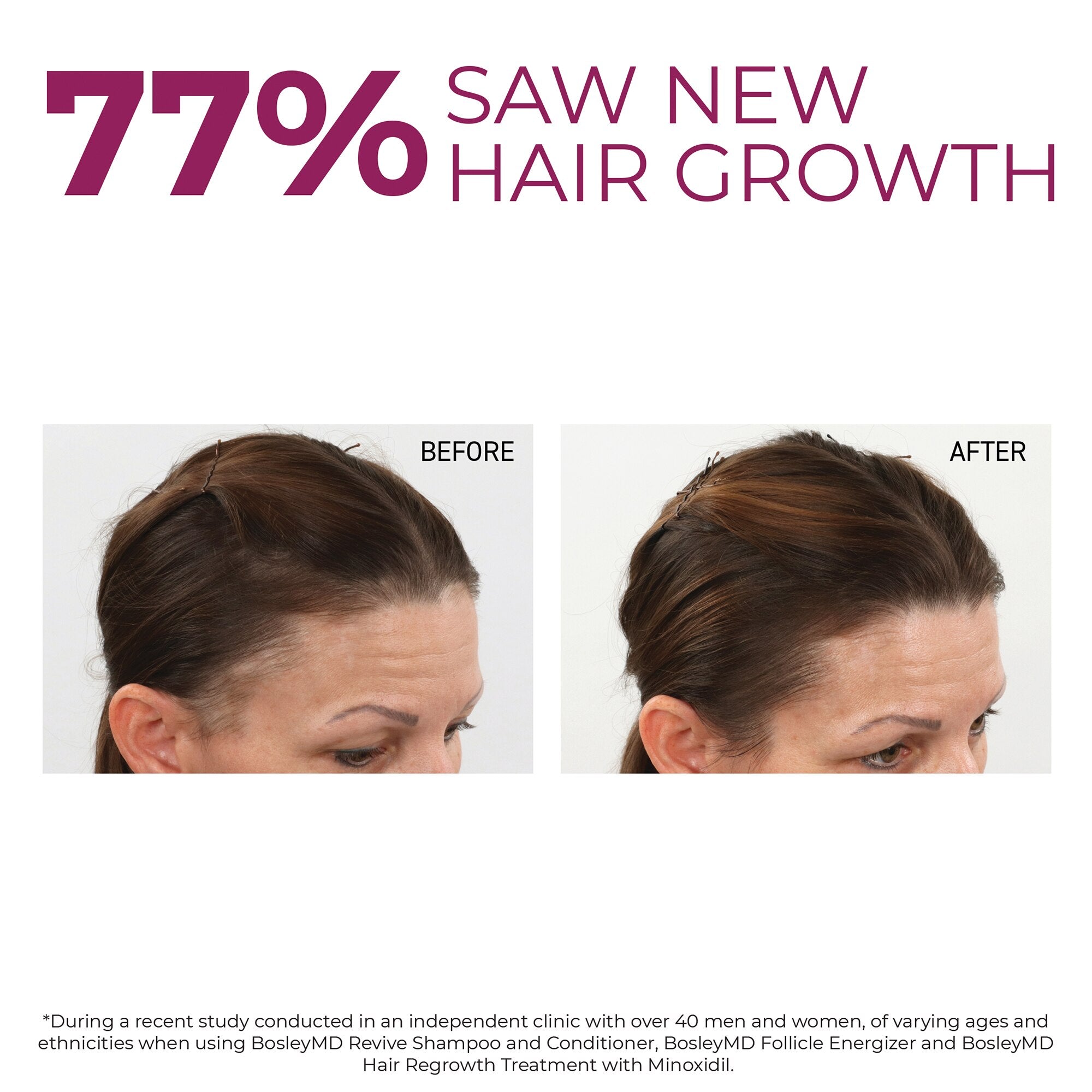 Bosley MD Women's Hair Regrowth Sprayer 2 Count, 2 OZ ea